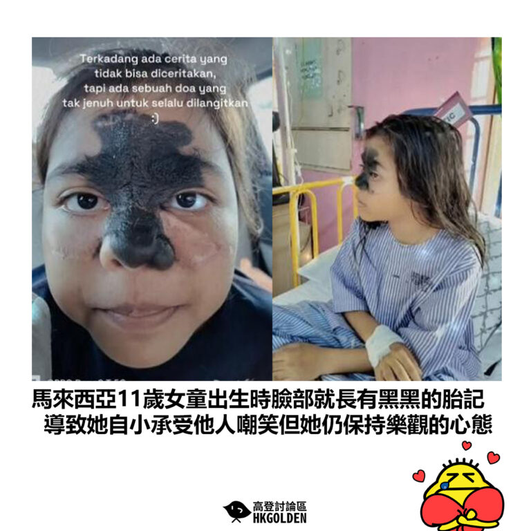 【馬來西亞11歲女童出生時臉部就長有黑黑的胎記 導致她自小承受他人嘲笑但她仍保持樂觀的心態】