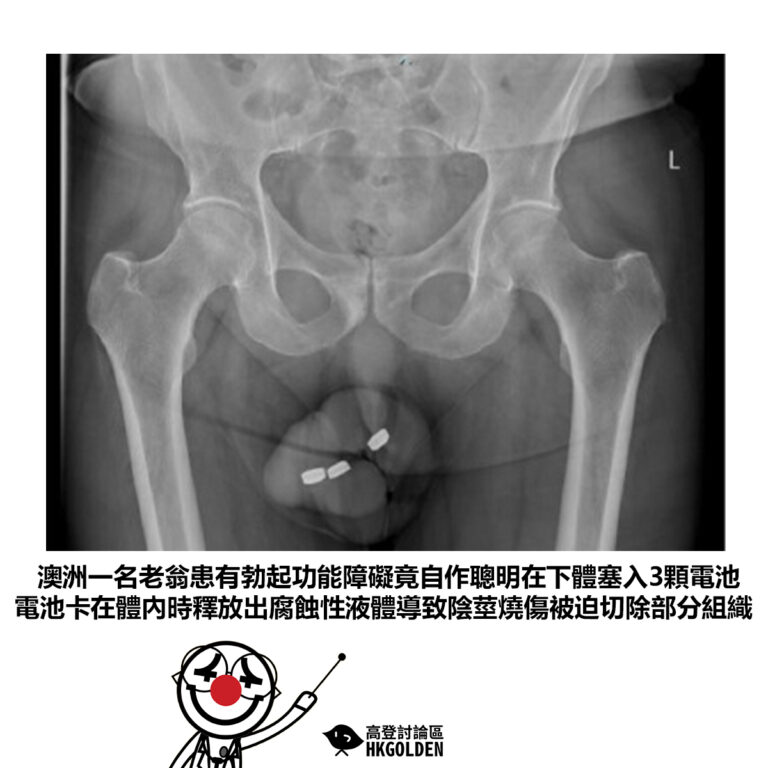 【澳洲一名老翁患有勃起功能障礙竟在下體塞入3顆電池 電池卡在體內時釋放出腐蝕性液體導致陰莖燒傷被迫切除部分組織】