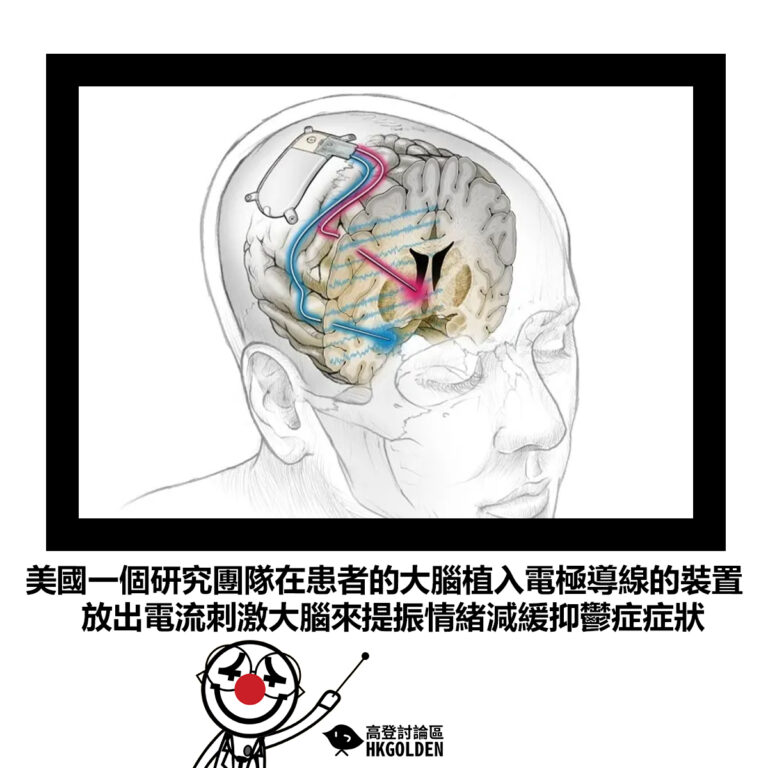 【美國一個研究團隊在患者的大腦植入電極導線的裝置 放出電流刺激大腦來提振情緒減緩抑鬱症症狀】