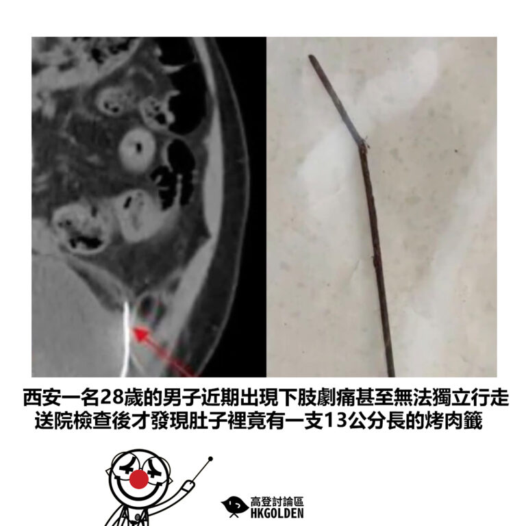 【西安一名28歲的男子近期出現下肢劇痛甚至無法獨立行走 送院檢查後才發現肚子裡竟有一支13公分長的烤肉籤】