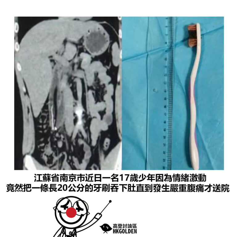 【江蘇省南京市近日一名17歲少年因為情緒激動 竟然把一條長20公分的牙刷吞下肚直到發生嚴重腹痛才送院】