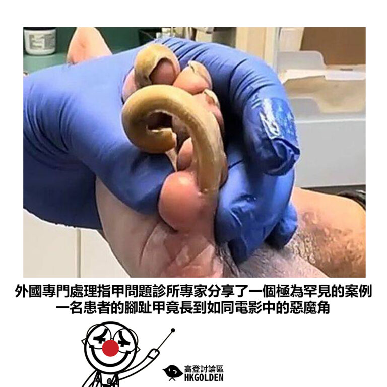 【外國專門處理指甲問題診所專家分享了一個極為罕見的案例 一名患者的腳趾甲竟長到如同電影中的惡魔角】