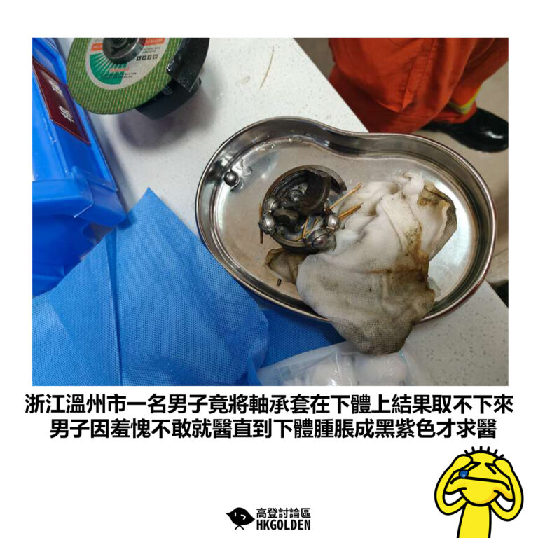 【浙江溫州市一名男子竟將軸承套在下體上結果取不下來 男子因羞愧不敢就醫直到下體腫脹成黑紫色才求醫】