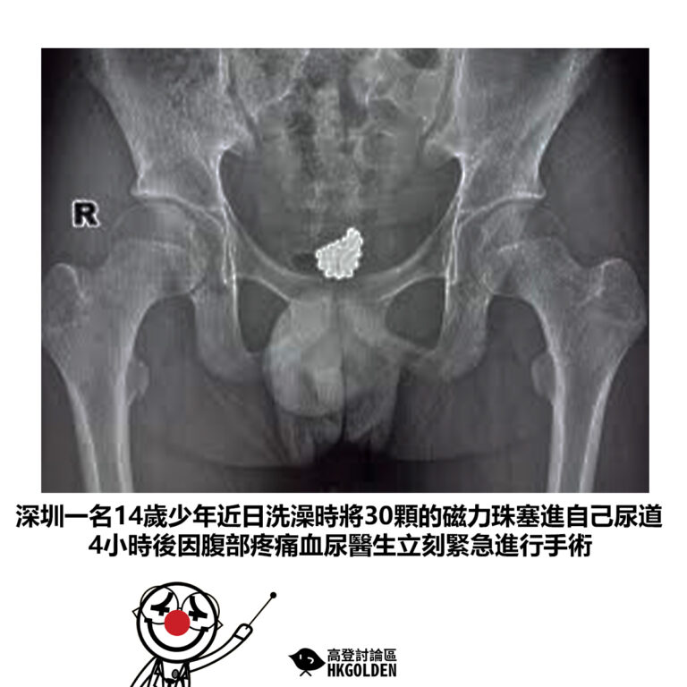 【深圳一名14歲少年近日洗澡時將30顆的磁力珠塞進自己尿道 4小時後因腹部疼痛血尿醫生立刻緊急進行手術】