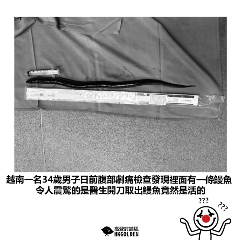 【越南一名34歲男子日前腹部劇痛檢查發現裡面有一條鰻魚 令人震驚的是醫生開刀取出鰻魚竟然是活的】