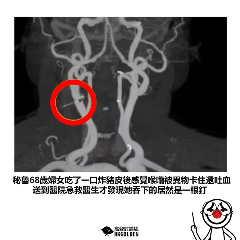 【秘魯68歲婦女吃了一口炸豬皮後感覺喉嚨被異物卡住還吐血 送到醫院急救醫生才發現她吞下的居然是一根釘】