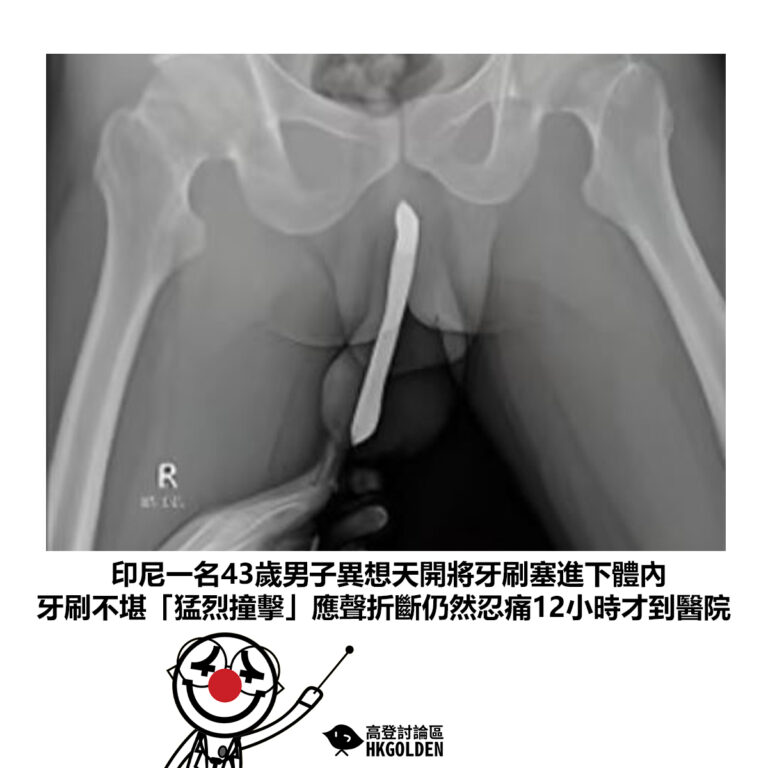 【印尼一名43歲男子異想天開將牙刷塞進下體內 牙刷不堪「猛烈撞擊」應聲折斷仍然忍痛12小時才到醫院】