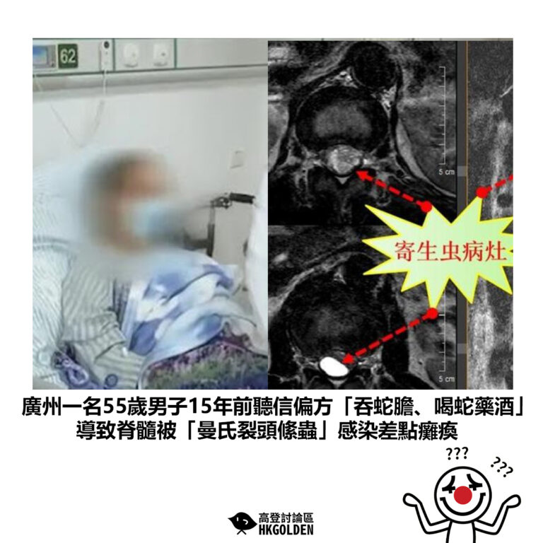 【廣州一名55歲男子15年前聽信偏方「吞蛇膽、喝蛇藥酒」 導致脊髓被「曼氏裂頭絛蟲」感染差點癱瘓】