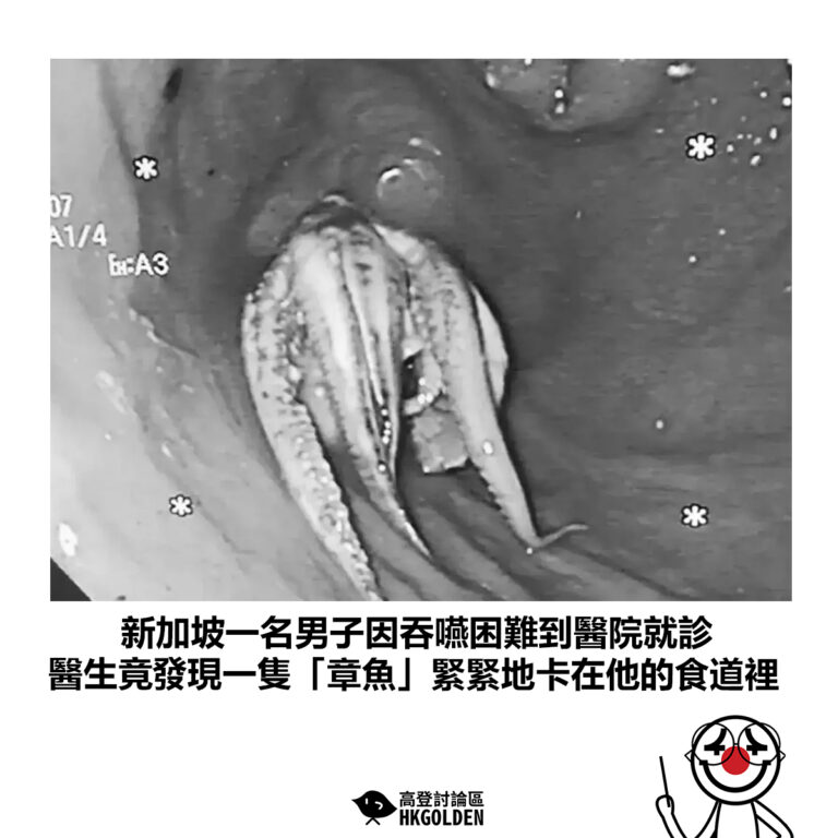 【新加坡一名男子因吞嚥困難到醫院就診 醫生竟發現一隻「章魚」緊緊地卡在他的食道裡】