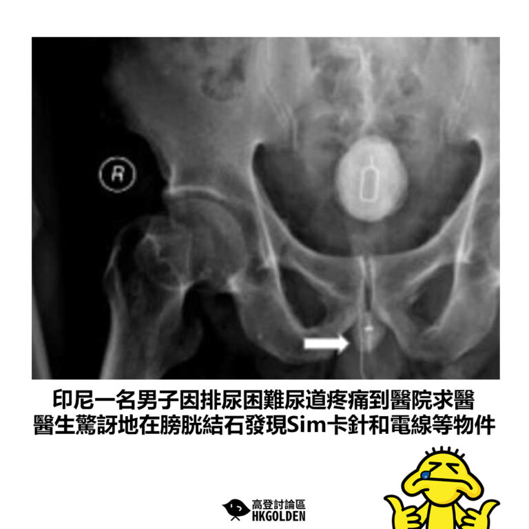 【印尼一名男子因排尿困難尿道疼痛到醫院求醫 醫生驚訝地在膀胱結石發現Sim卡針和電線等物件】