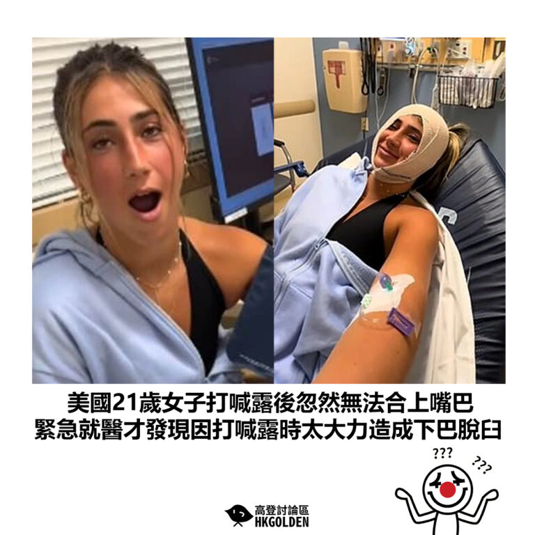 【美國21歲女子打喊露後忽然無法合上嘴巴 緊急就醫才發現因打喊露時太大力造成下巴脫臼】