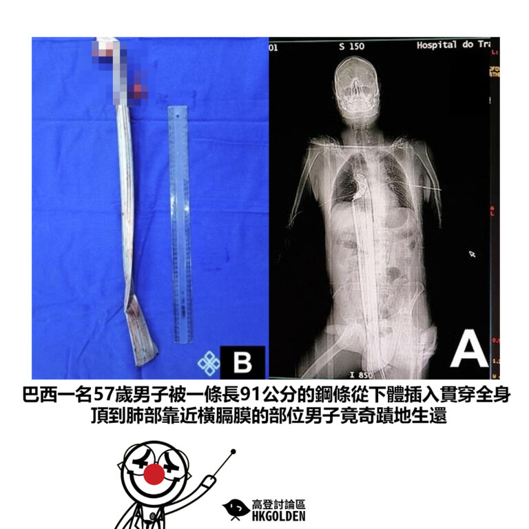 【巴西一名57歲男子被一條長91公分的鋼條從下體插入貫穿全身頂到肺部靠近橫膈膜的部位男子竟奇蹟地生還】