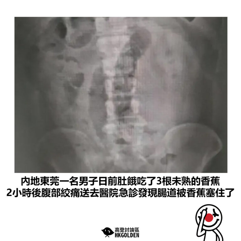 【內地東莞一名男子日前肚餓吃了3根未熟的香蕉 2小時後腹部絞痛送去醫院急診發現腸道被香蕉塞住了】