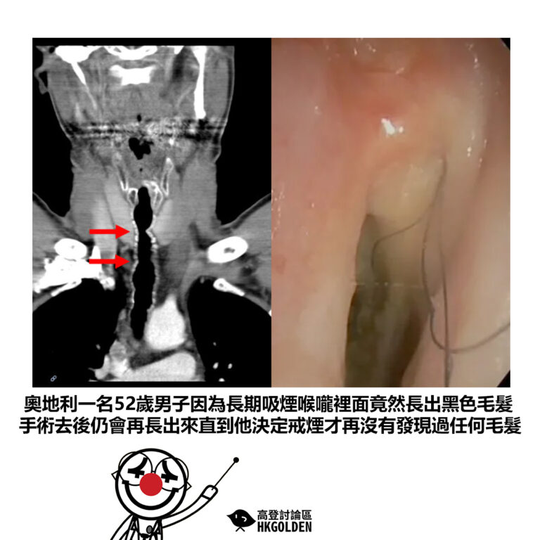 【奧地利一名52歲男子因為長期吸煙喉嚨裡面竟然長出黑色毛髮手術去後仍會再長出來直到他決定戒煙才再沒有發現過任何毛髮】