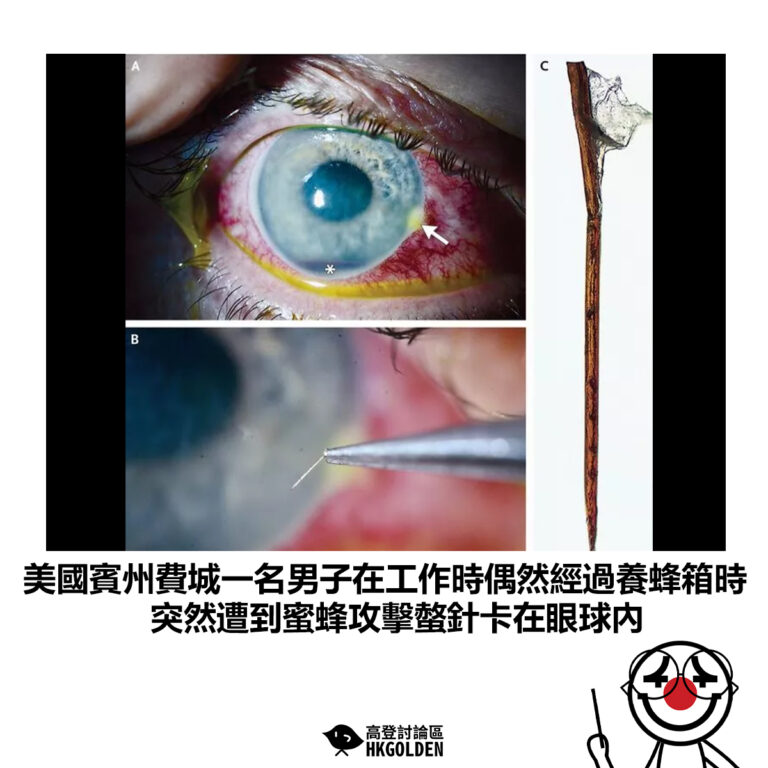 【美國賓州費城一名男子在工作時偶然經過養蜂箱時 突然遭到蜜蜂攻擊螫針卡在眼球內】