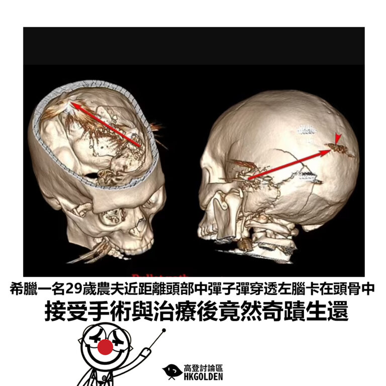 【希臘一名29歲農夫近距離頭部中彈子彈穿透左腦卡在頭骨中 接受手術與治療後竟然奇蹟生還】