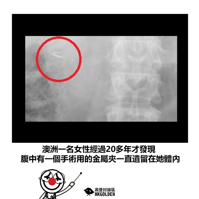 【澳洲一名女性經過20多年才發現 腹中有一個手術用的金屬夾一直遺留在她體內】