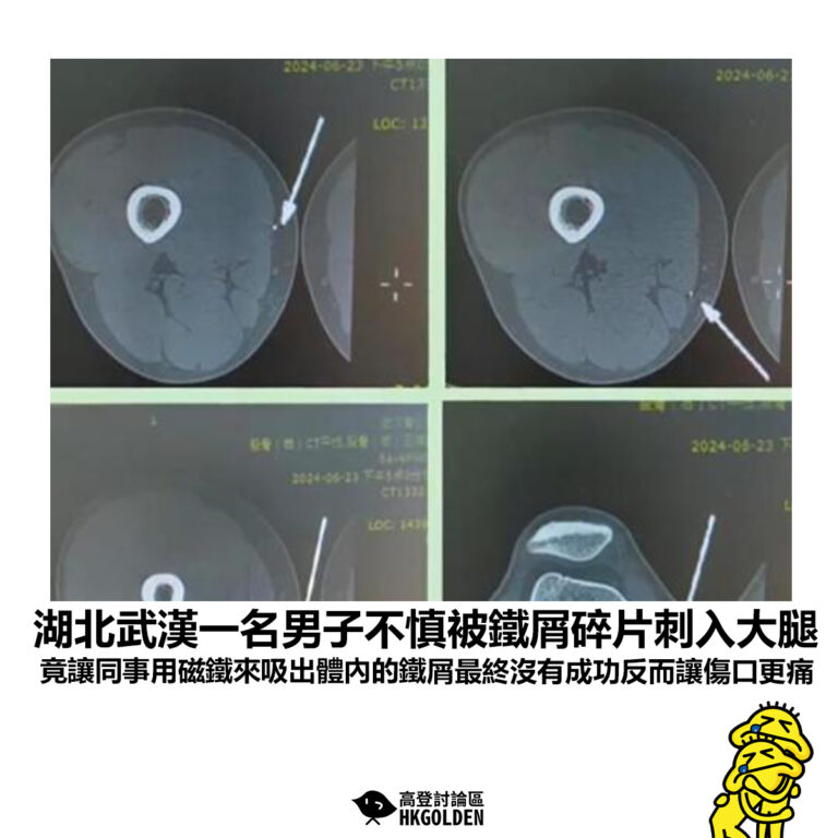 【湖北武漢一名男子不慎被鐵屑碎片刺入大腿 竟讓同事用磁鐵來吸出體內的鐵屑最終沒有成功反而讓傷口更痛】