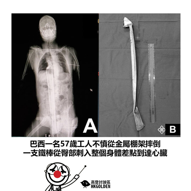 【巴西一名57歲工人不慎從金屬棚架摔倒 一支鐵棒從臀部刺入整個身體差點到達心臟】