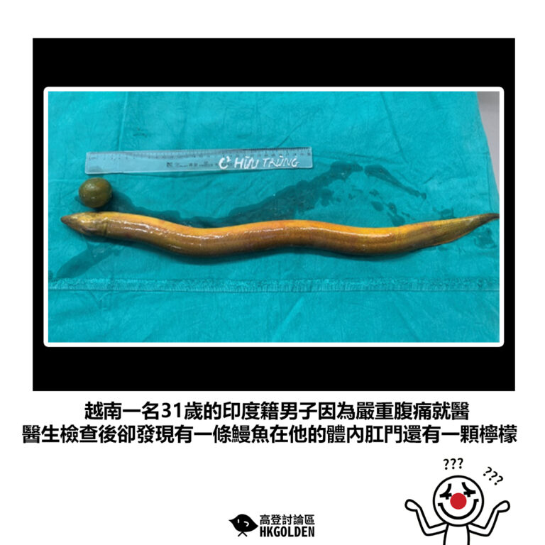 【越南一名31歲的印度籍男子因為嚴重腹痛就醫 醫生檢查後卻發現有一條鰻魚在他的體內肛門還有一顆檸檬】