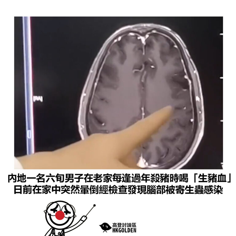 【內地一名六旬男子在老家每逢過年殺豬時喝「生豬血」 日前在家中突然暈倒經檢查發現腦部被寄生蟲感染】