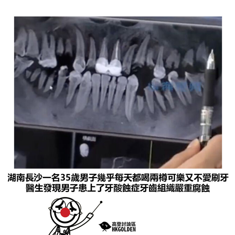【湖南長沙一名35歲男子幾乎每天都喝兩樽可樂又不愛刷牙 醫生發現男子患上了牙酸蝕症牙齒組織嚴重腐蝕】