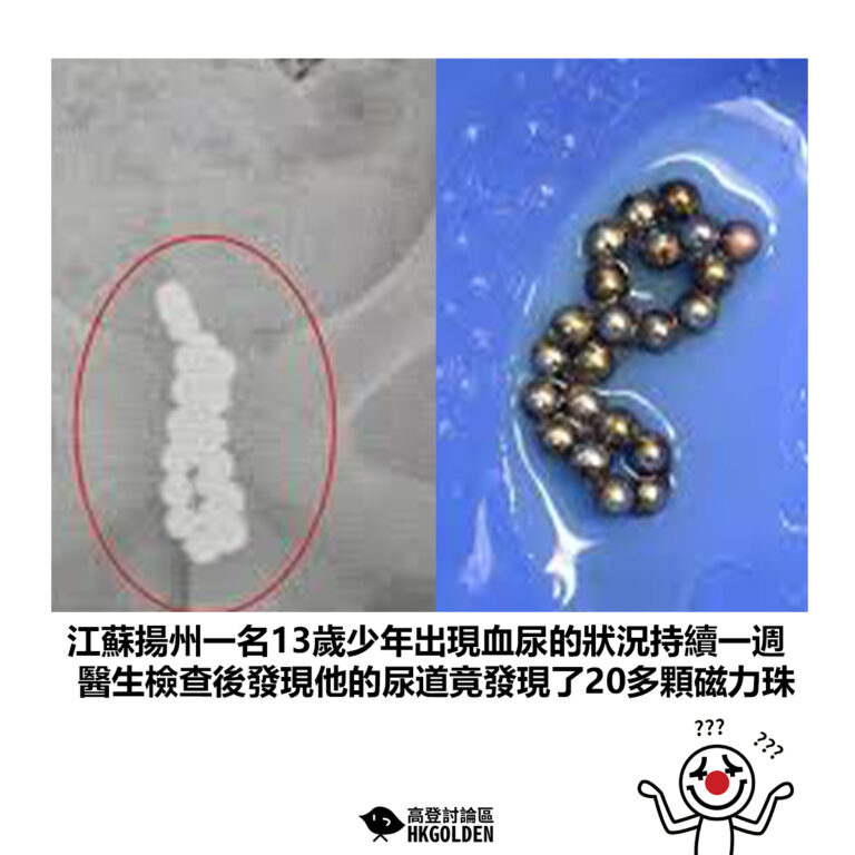 【江蘇揚州一名13歲少年出現血尿的狀況持續一週 醫生檢查後發現他的尿道竟發現了20多顆磁力珠】