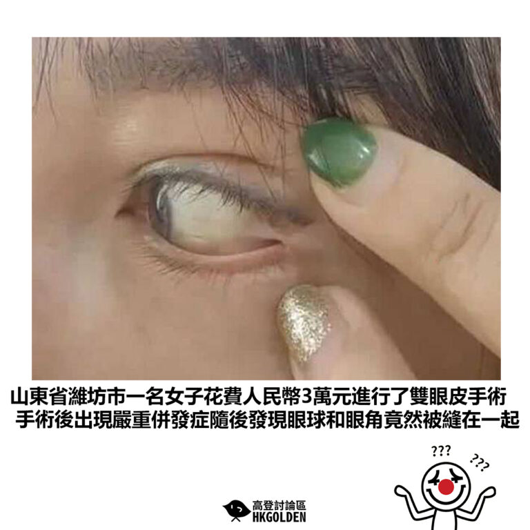 【山東省濰坊市一名女子花費人民幣3萬元進行了雙眼皮手術  手術後出現嚴重併發症隨後發現眼球和眼角竟然被縫在一起 】