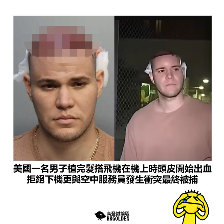 【美國一名男子植完髮搭飛機在機上時頭皮開始出血 拒絕下機更與空中服務員發生衝突最終被捕】