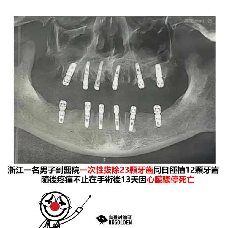 【浙江一名男子到醫院一次性拔除23顆牙齒同日種植12顆牙齒 隨後疼痛不止在手術後13天因心臟驟停死亡】