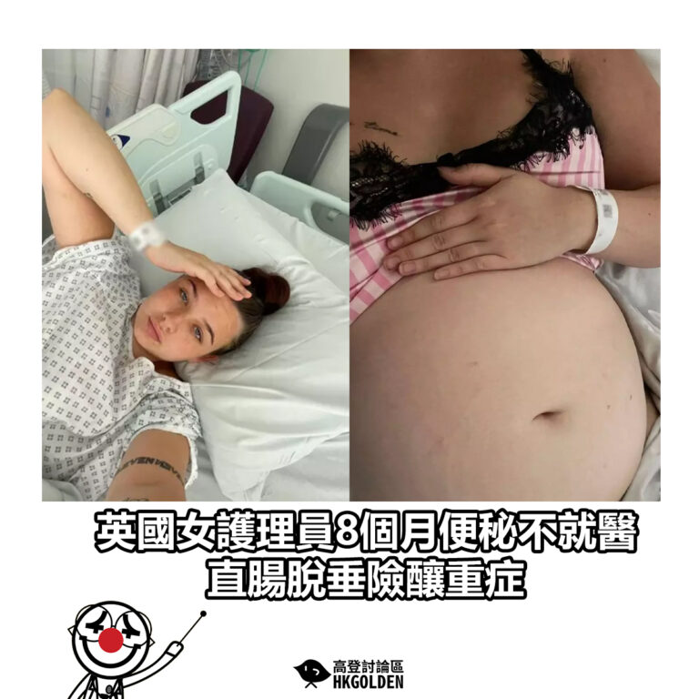 【英國女護理員8個月便秘不就醫　直腸脫垂險釀重症】