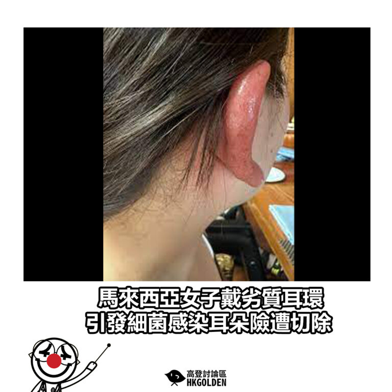 【馬來西亞女子戴劣質耳環引發細菌感染　耳朵險遭切除】