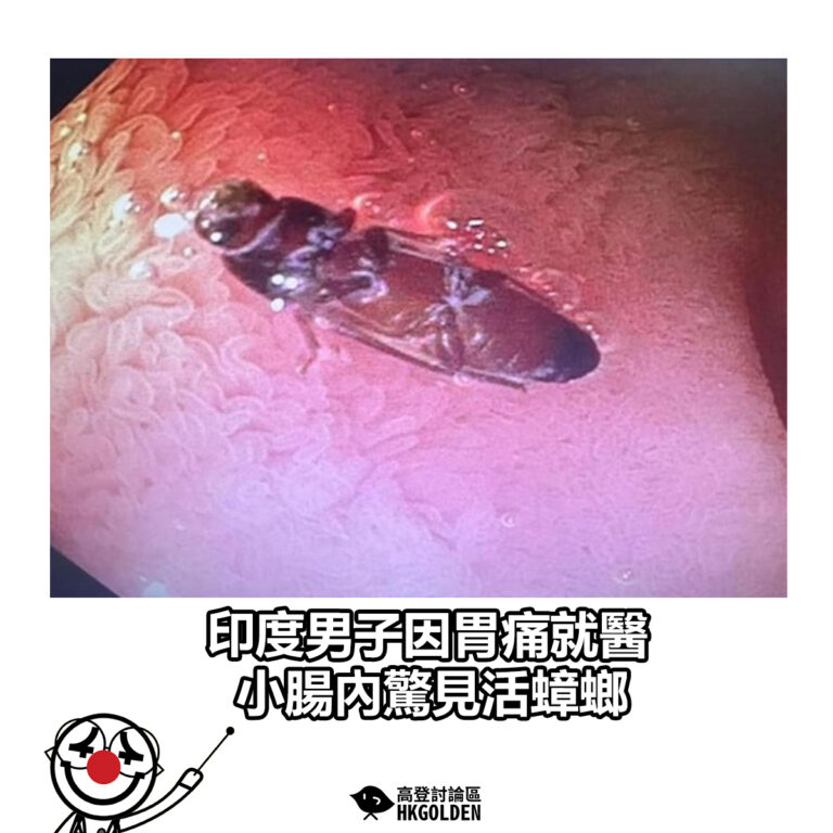 【印度男子因胃痛就醫　小腸內驚見活蟑螂】