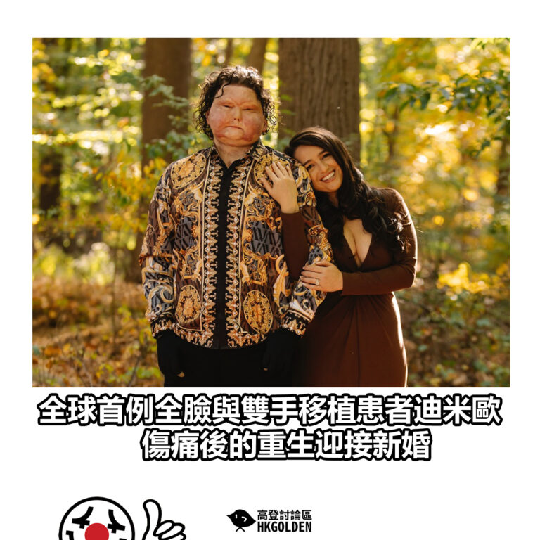 【全球首例全臉與雙手移植患者迪米歐 傷痛後的重生迎接新婚】