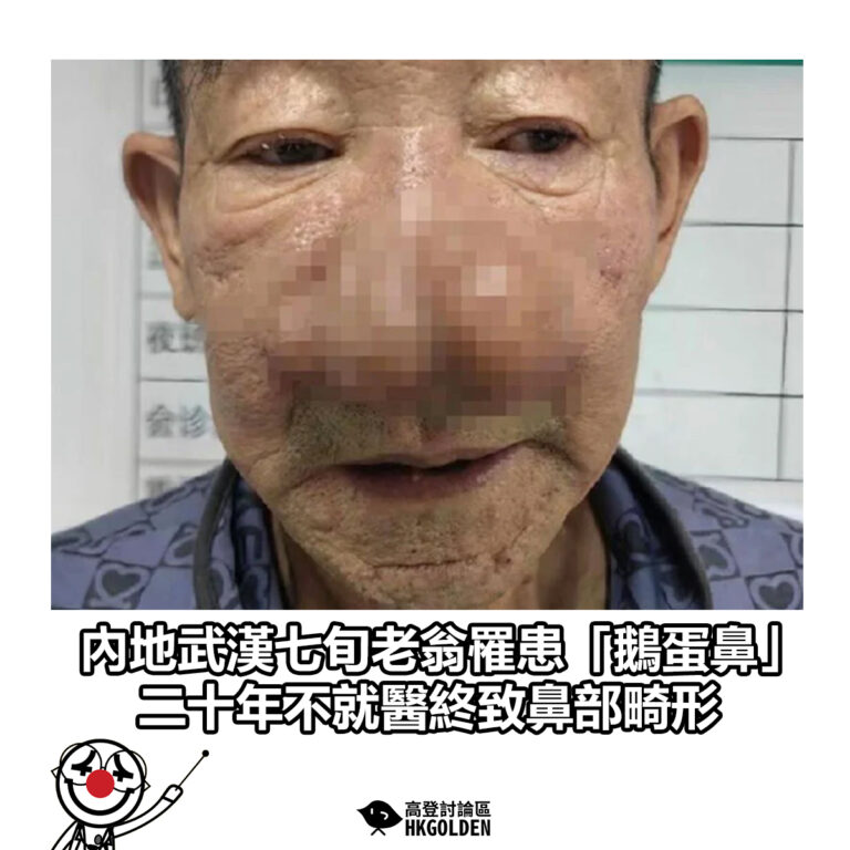 【內地武漢七旬老翁罹患「鵝蛋鼻」 二十年不就醫終致鼻部畸形】