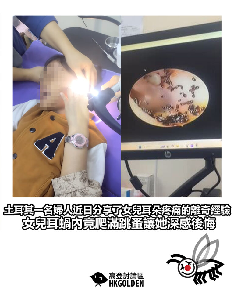 【土耳其一名婦人近日在網絡上分享了女兒耳朵疼痛的離奇經驗 女兒耳蝸內竟爬滿跳蚤讓她深感後悔】