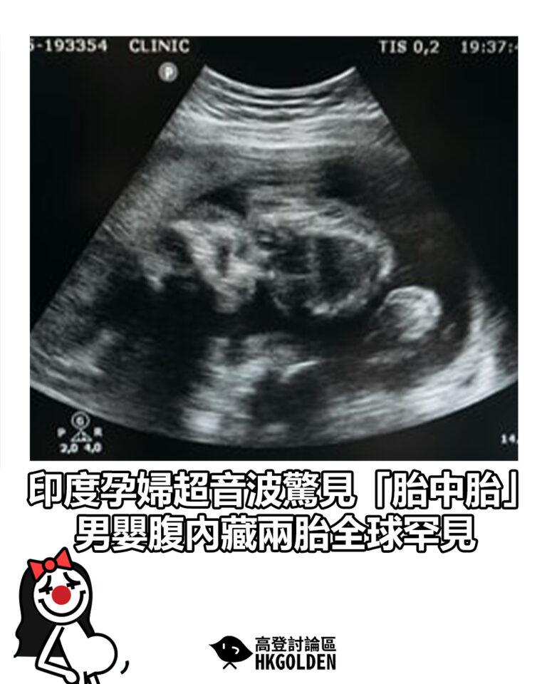 【印度孕婦超音波驚見「胎中胎」　男嬰腹內藏兩胎全球罕見】
