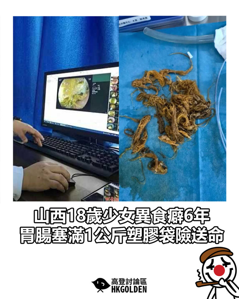 【山西18歲少女異食癖6年　胃腸塞滿1公斤塑膠袋險送命】
