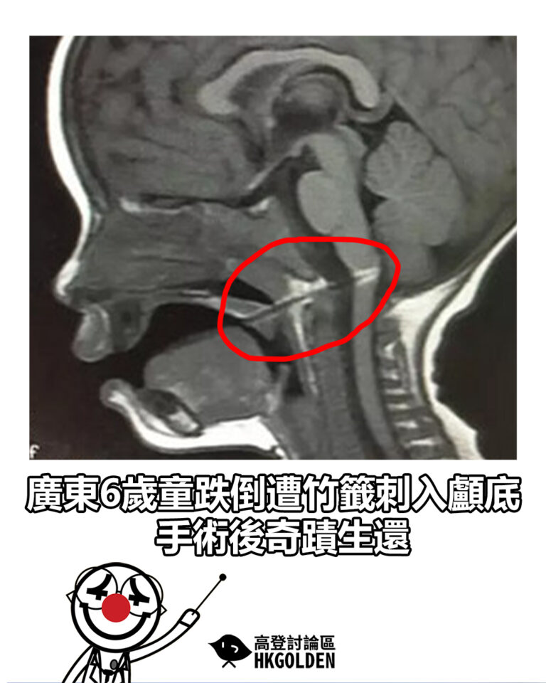 【廣東6歲童跌倒遭竹籤刺入顱底 手術後奇蹟生還】