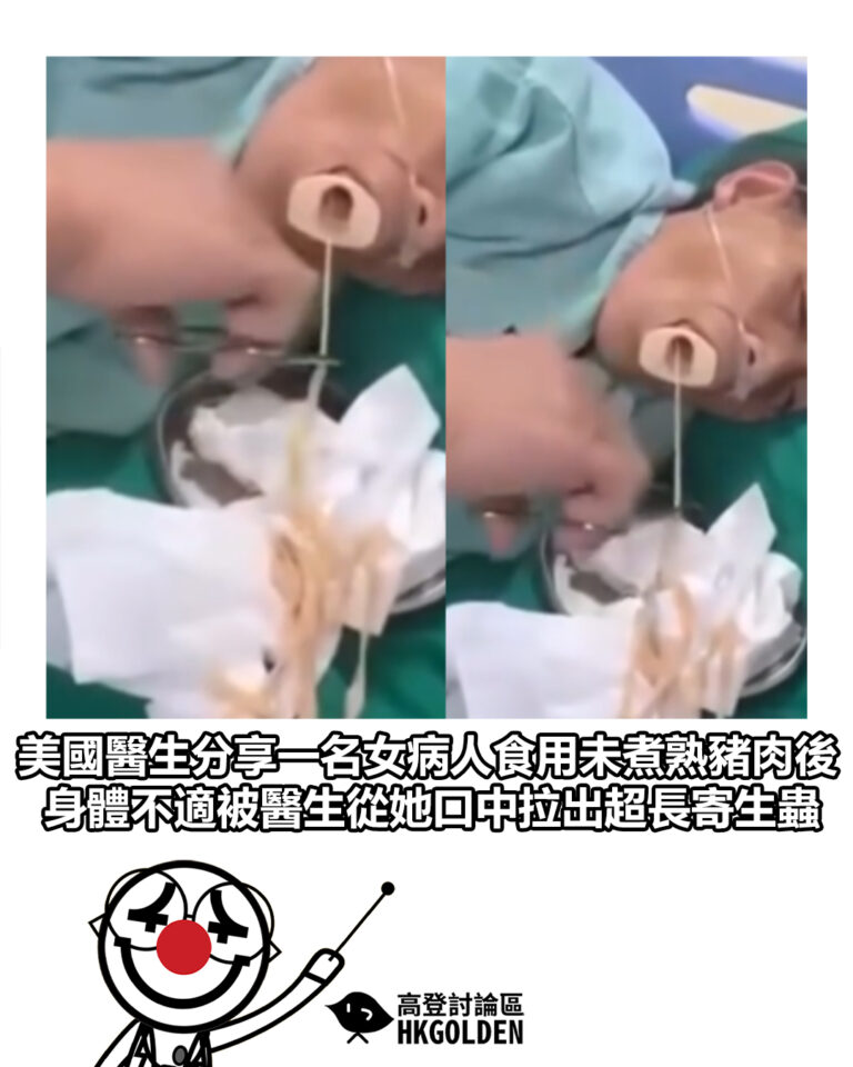 【美國醫生分享一名女病人食用未煮熟豬肉後身體不適 事後被醫生從她口中拉出超長寄生蟲】