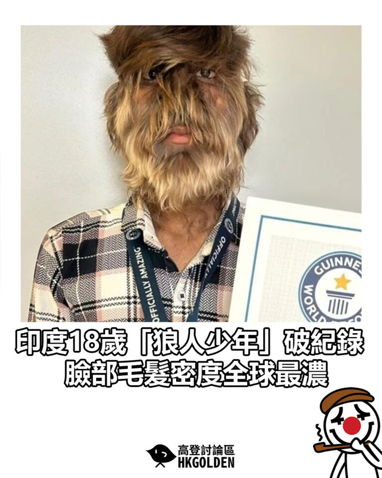 【印度18歲「狼人少年」破紀錄　臉部毛髮密度全球最濃】