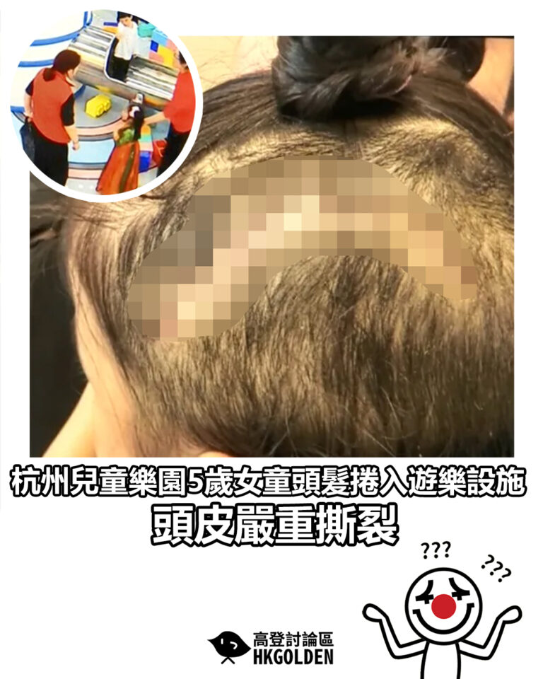 【杭州兒童樂園5歲女童頭髮捲入遊樂設施 頭皮嚴重撕裂】