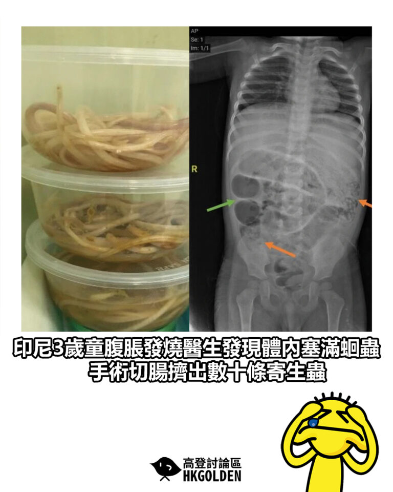 【印尼3歲童腹脹發燒醫生發現體內塞滿蛔蟲　手術切腸擠出數十條寄生蟲】