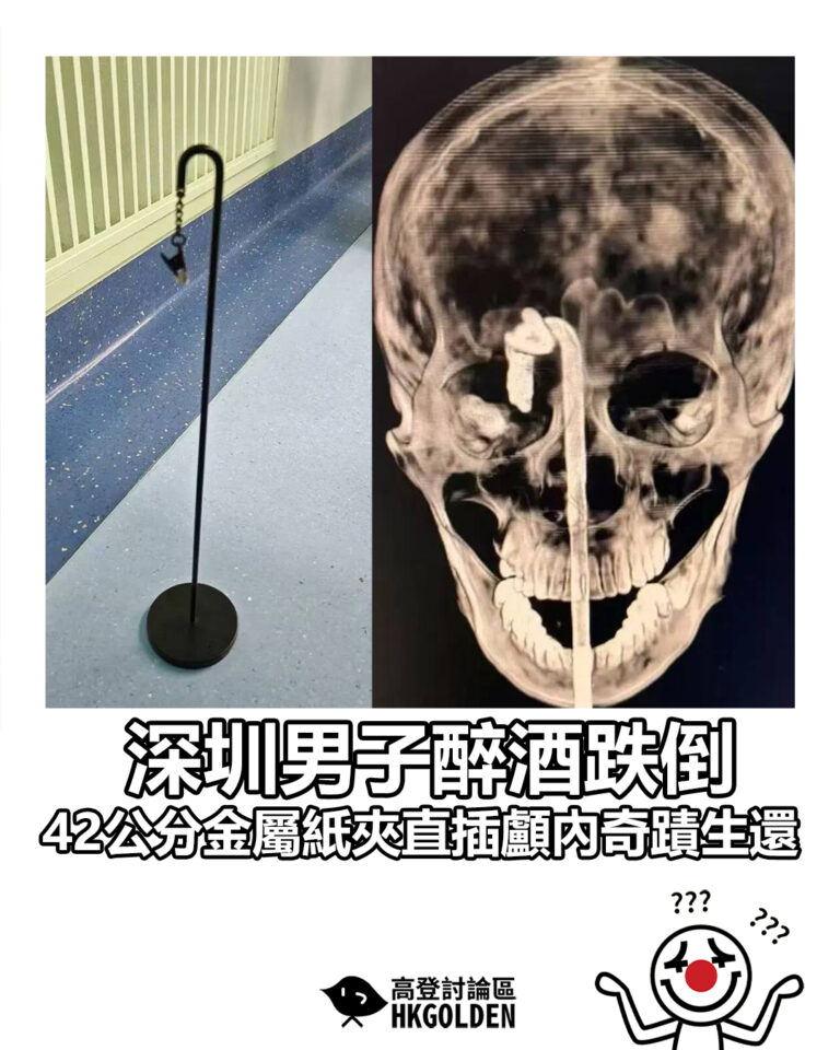 【深圳男子醉酒跌倒　42公分金屬紙夾直插顱內奇蹟生還】