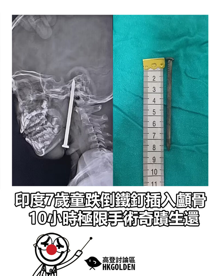 【印度7歲童跌倒鐵釘插入顱骨　10小時極限手術奇蹟生還】