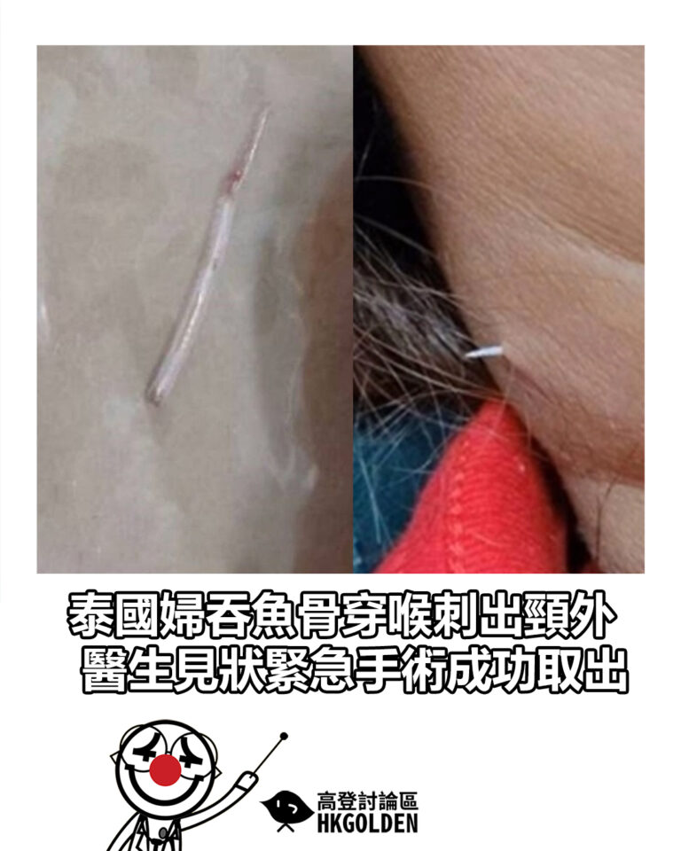 【泰國婦吞魚骨穿喉刺出頸外　醫生見狀緊急手術成功取出】