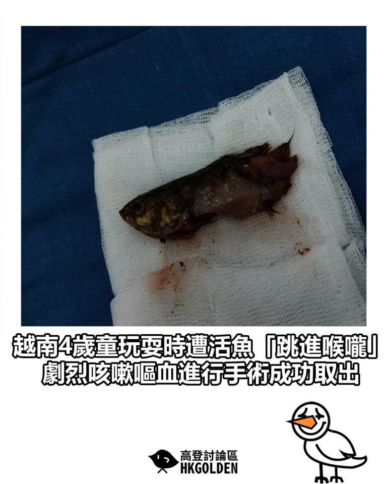 【越南4歲童玩耍時遭活魚「跳進喉嚨」　劇烈咳嗽嘔血進行手術成功取出】