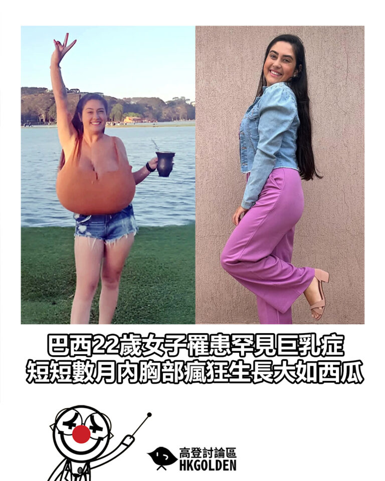 【巴西22歲女子罹患罕見巨乳症　短短數月內胸部瘋狂生長大如西瓜】