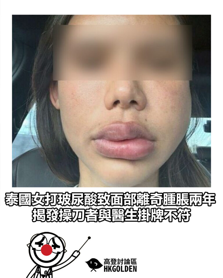 【泰國女打玻尿酸致面部離奇腫脹兩年 揭發操刀者與醫生掛牌不符】