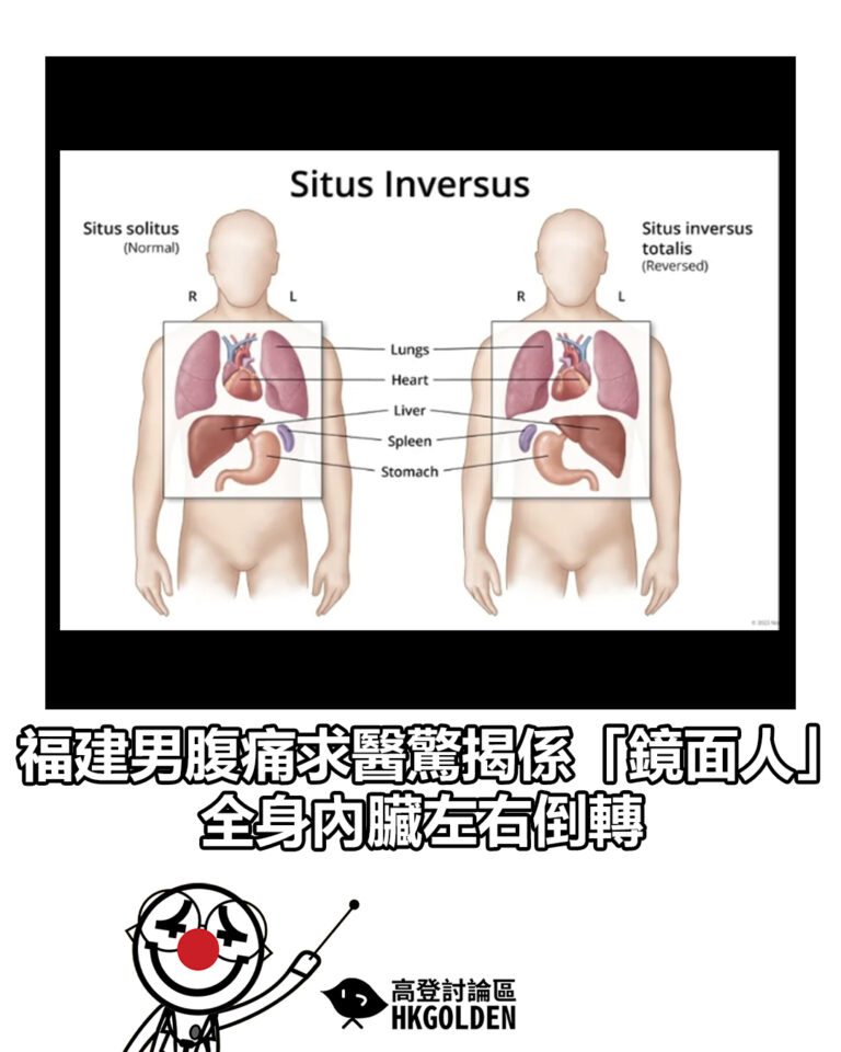 【福建男腹痛求醫驚揭係「鏡面人」 全身內臟左右倒轉】